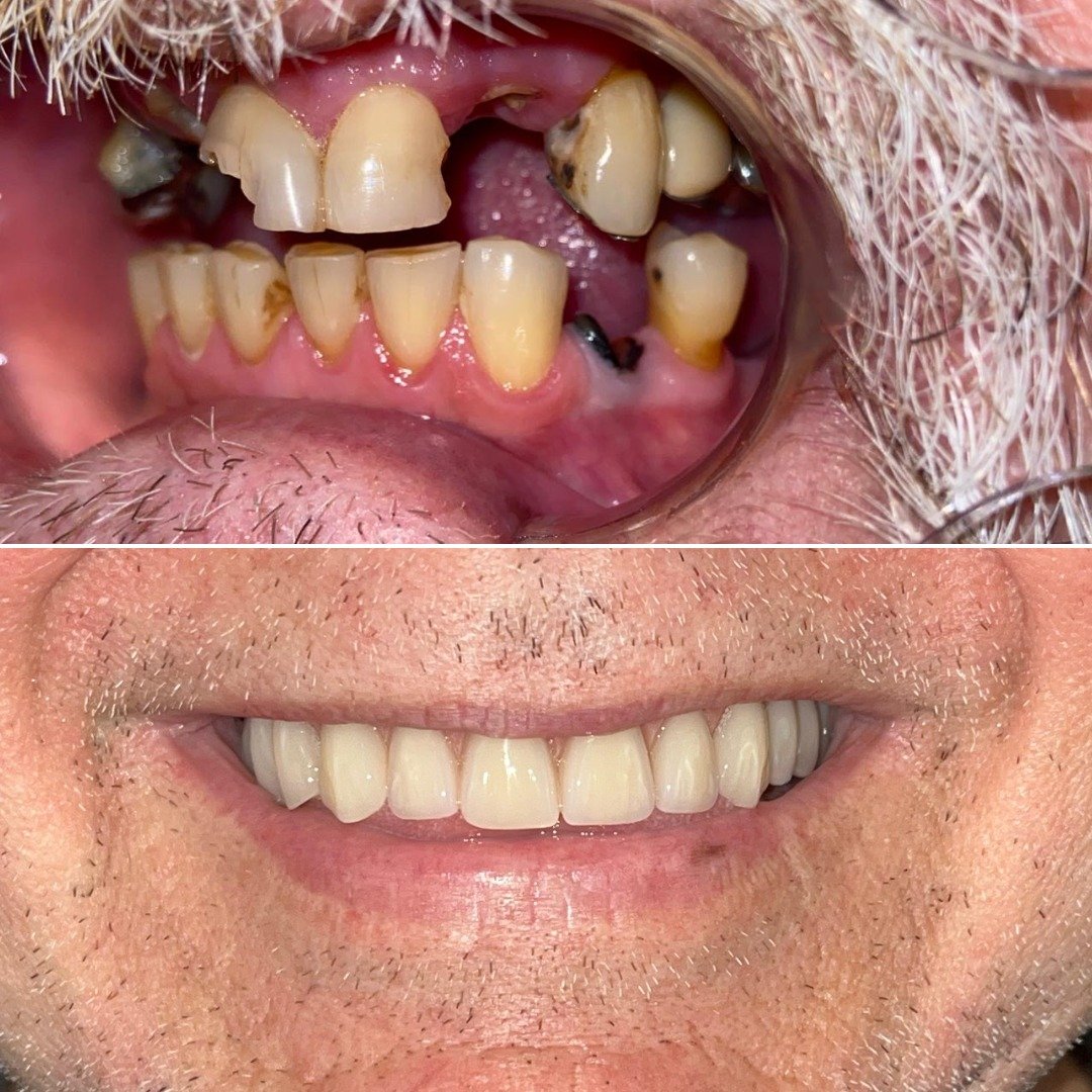 antes-depois1