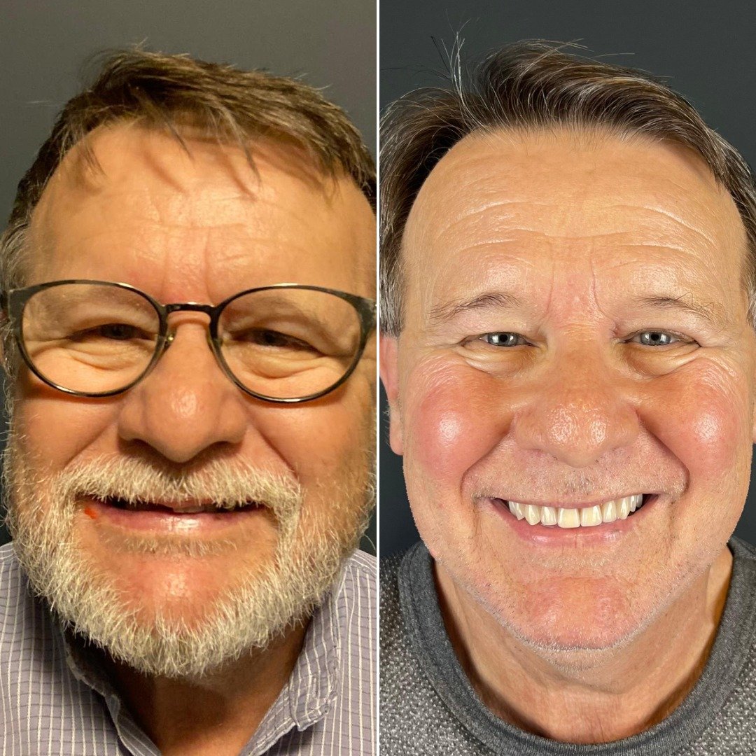 antes-depois3